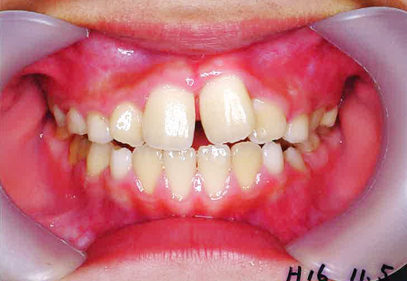 床矯正_症例01。2004/11/5時点の歯並び