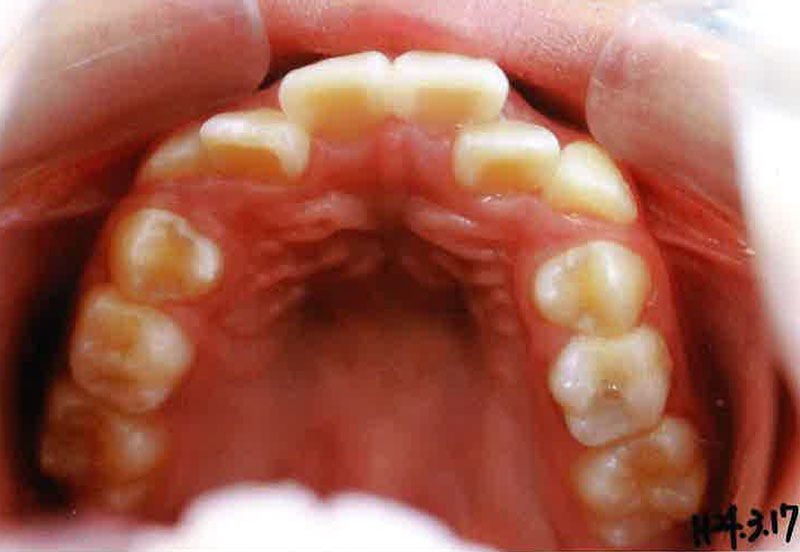 床矯正_症例02。2012/3/17時点の歯並び(上顎)
