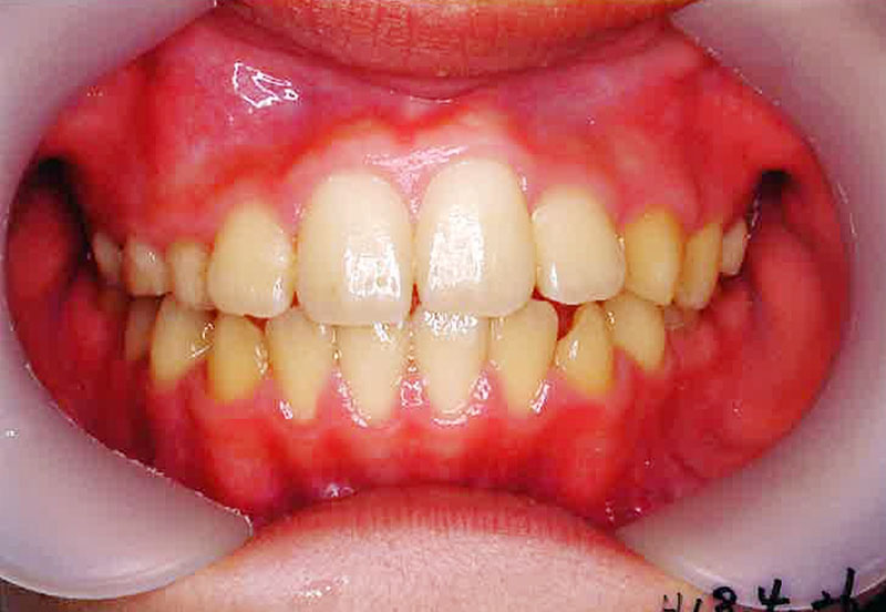 床矯正_症例01。2006/4/26時点の歯並び