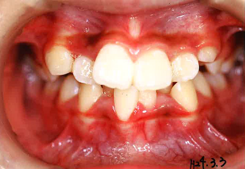 床矯正_症例02。2012/3/3時点の歯並び